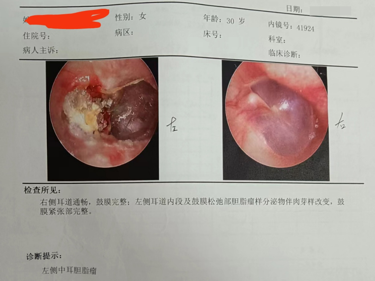 最新胆脂瘤手术价格解析与探讨