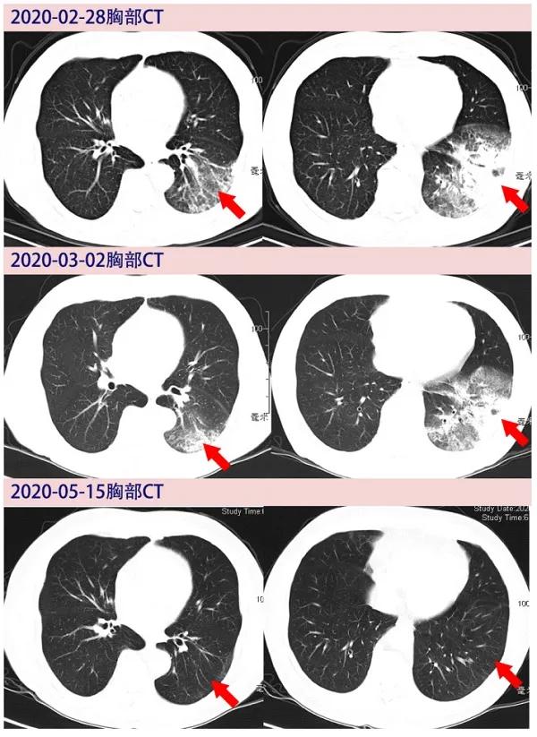 新冠肺炎研究最新现状