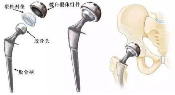 探索髋关节置换的最新材料